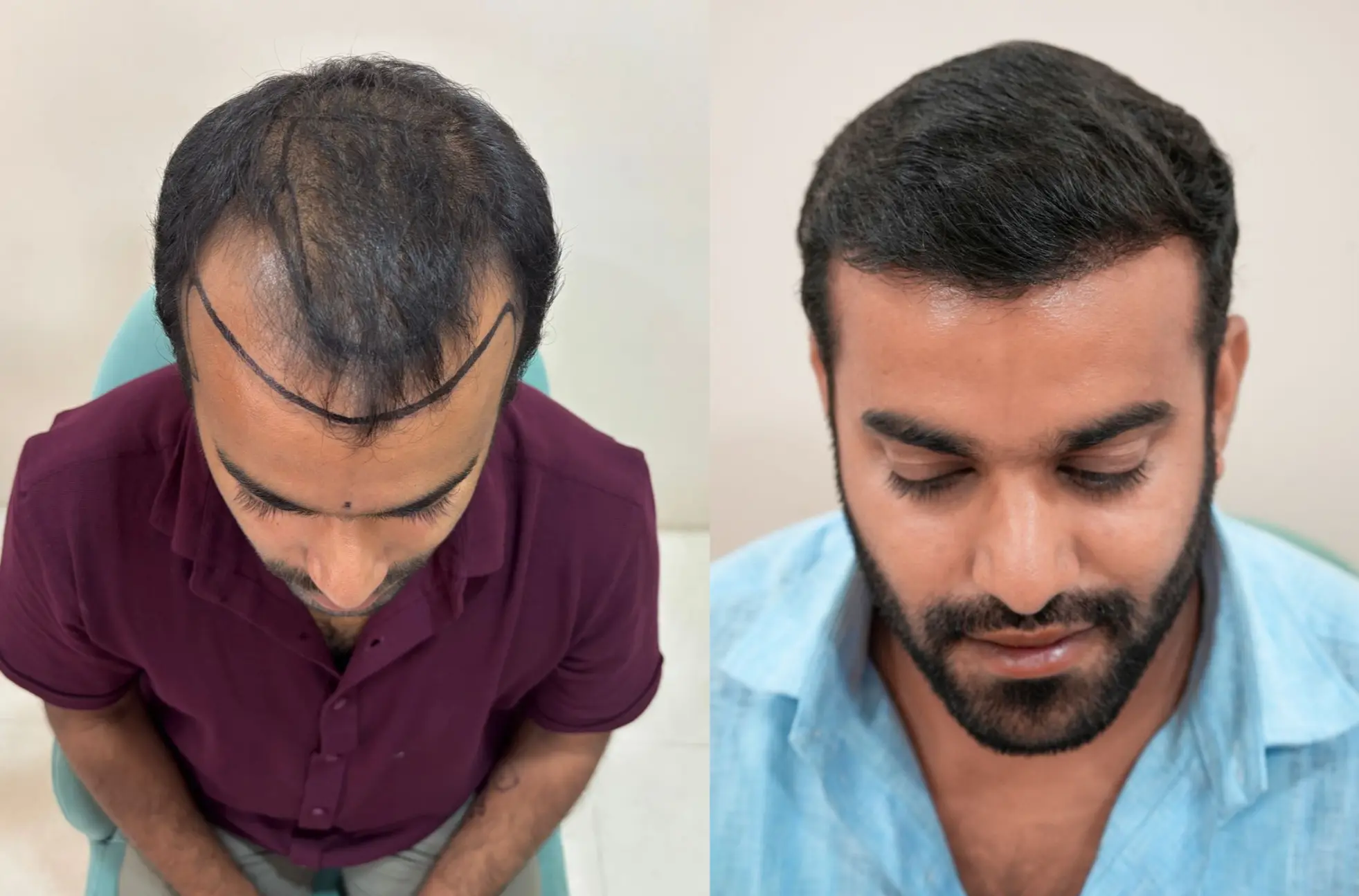 Hair Transplant Before and After Vizag