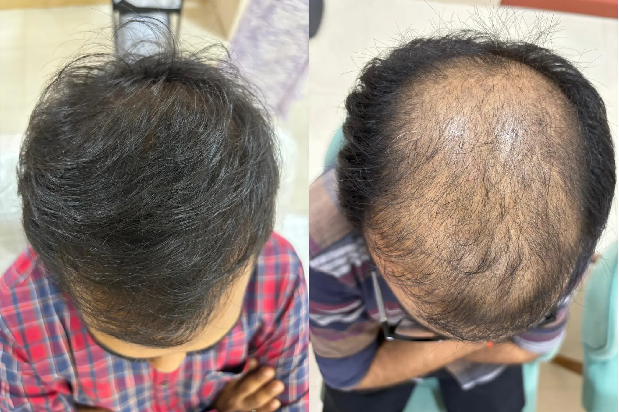 PRP Hair Treatment Before and After