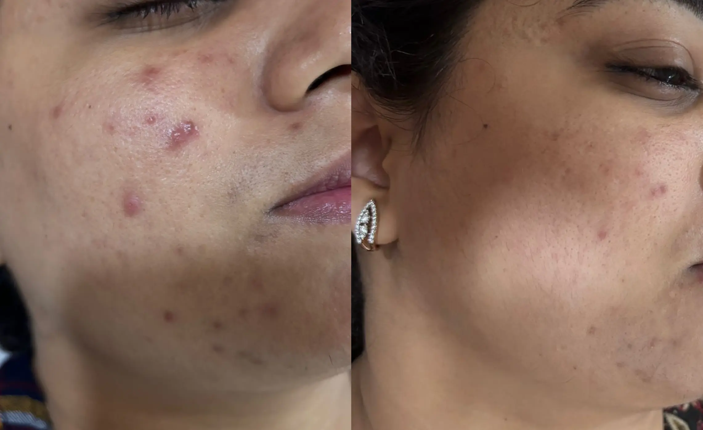 Acne Scar Treatment Before and After
