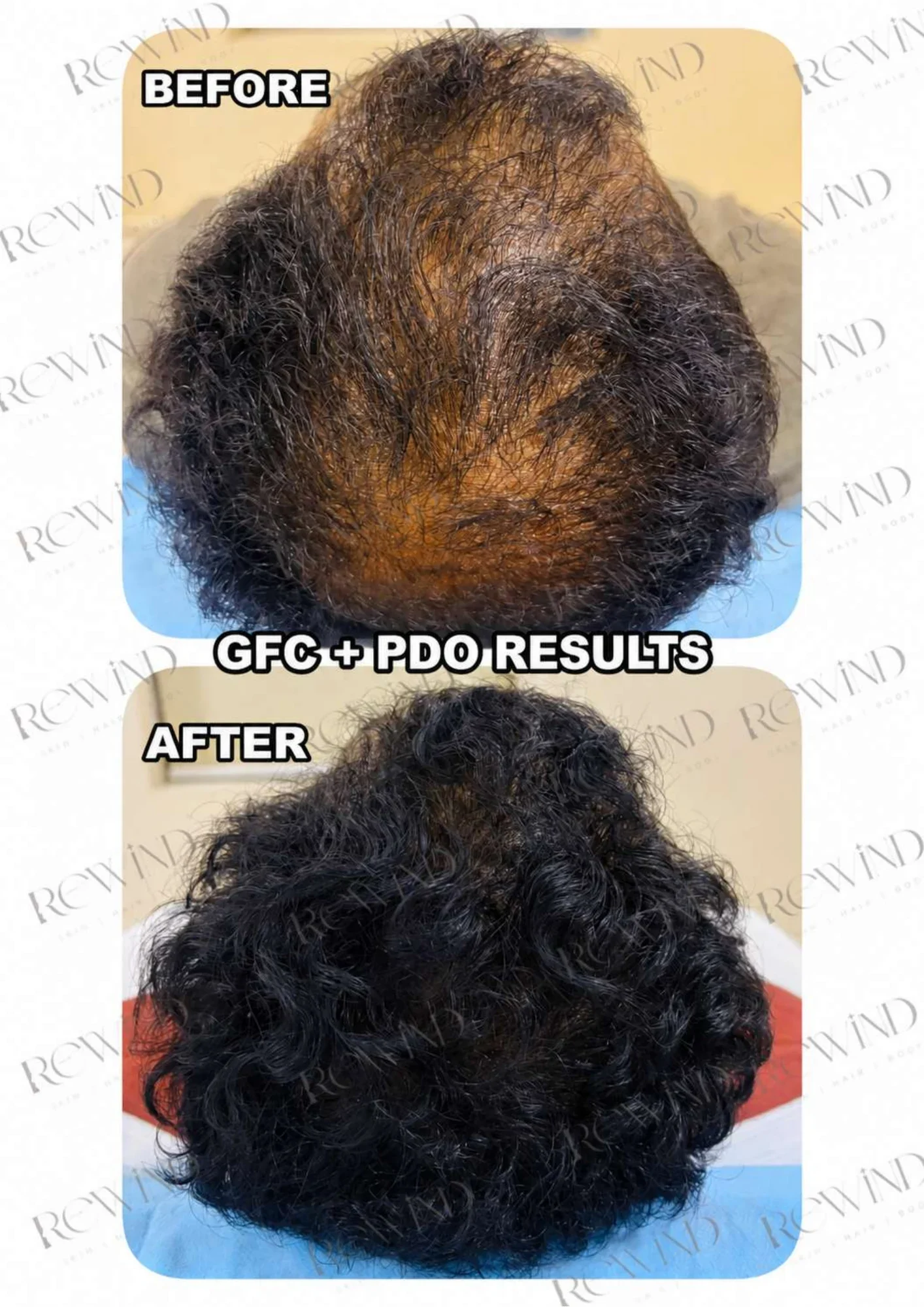 GFC Hair Treatment – Case 01